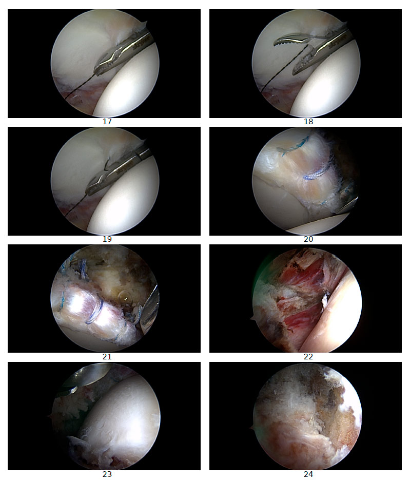 operación rotura labrum artroscopia cadera