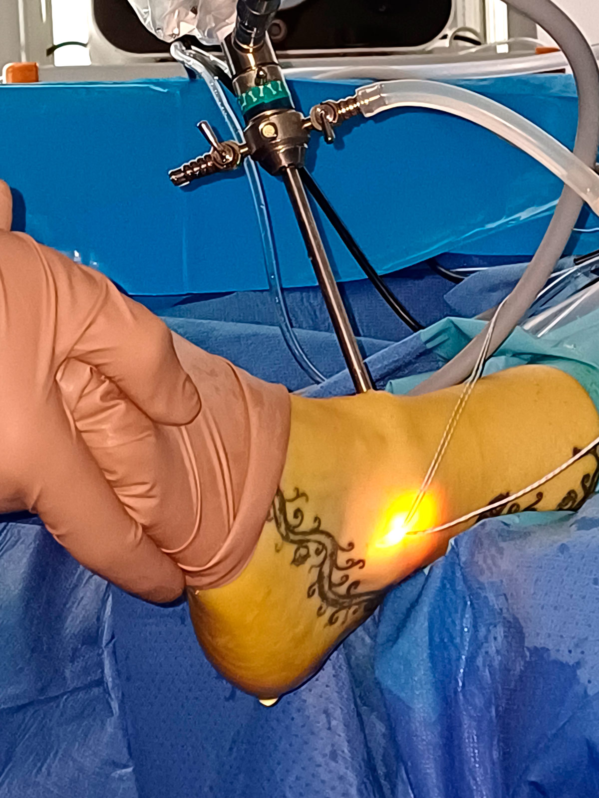Rotura de ligamentos de tobillo, artroscopia